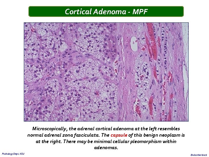 Cortical Adenoma - MPF Microscopically, the adrenal cortical adenoma at the left resembles normal