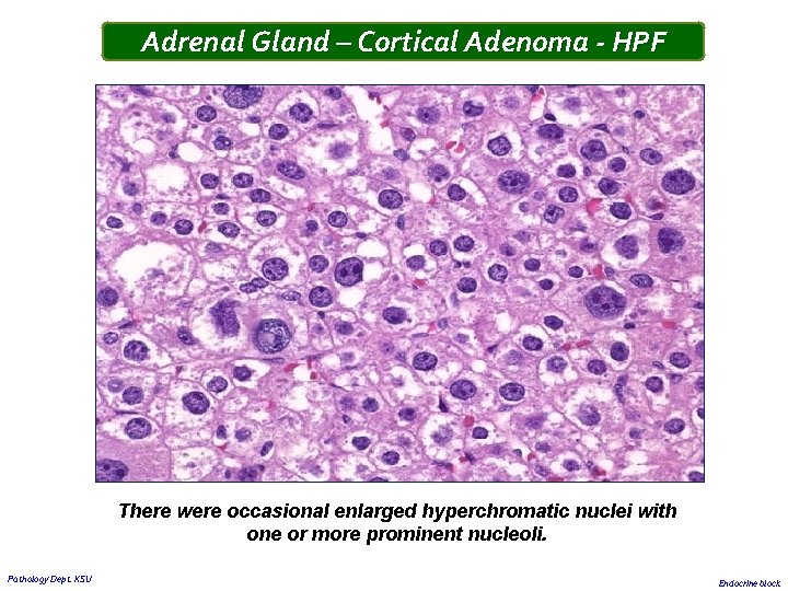 Adrenal Gland – Cortical Adenoma - HPF There were occasional enlarged hyperchromatic nuclei with