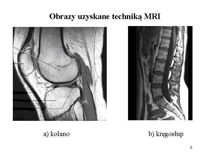 Obrazy uzyskane techniką MRI a) kolano b) kręgosłup 9 