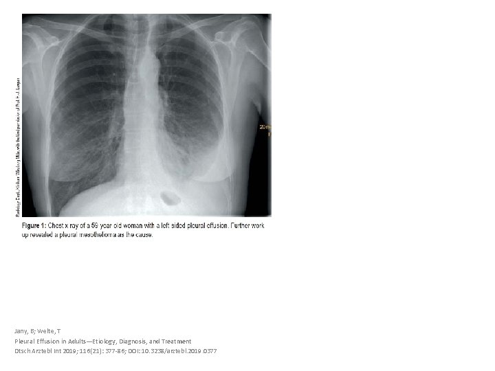 Jany, B; Welte, T Pleural Effusion in Adults—Etiology, Diagnosis, and Treatment Dtsch Arztebl Int