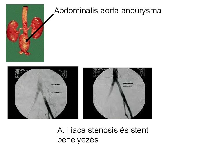 Abdominalis aorta aneurysma A. iliaca stenosis és stent behelyezés 