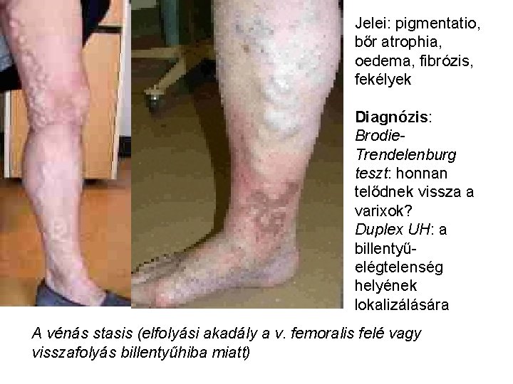 Jelei: pigmentatio, bőr atrophia, oedema, fibrózis, fekélyek Diagnózis: Brodie. Trendelenburg teszt: honnan telődnek vissza