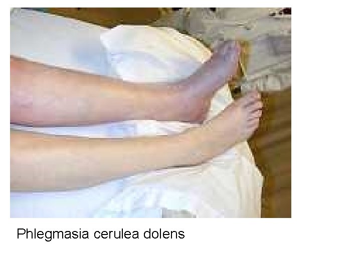 Phlegmasia cerulea dolens 
