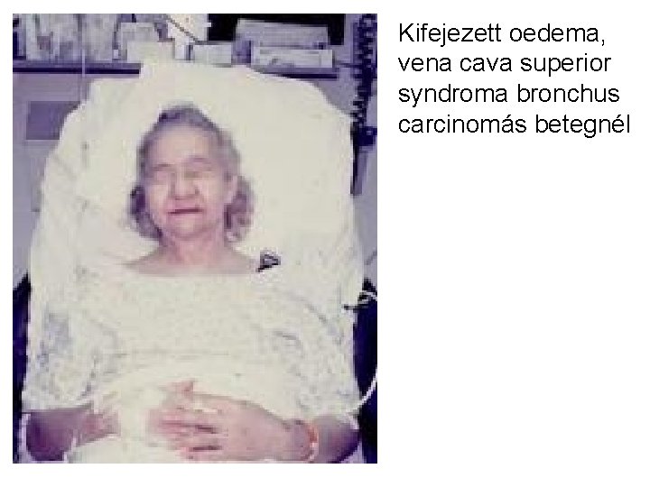 Kifejezett oedema, vena cava superior syndroma bronchus carcinomás betegnél 