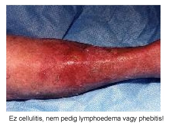 Ez cellulitis, nem pedig lymphoedema vagy phebitis! 