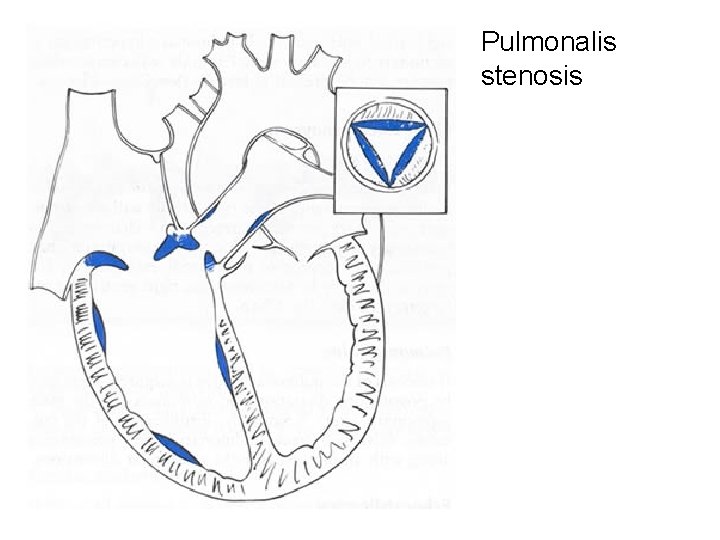 Pulmonalis stenosis 