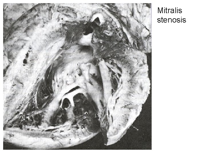 Mitralis stenosis 