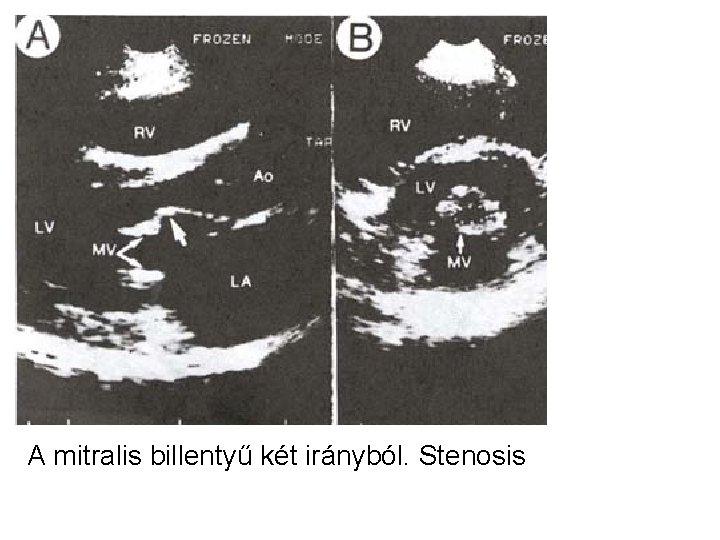 A mitralis billentyű két irányból. Stenosis 