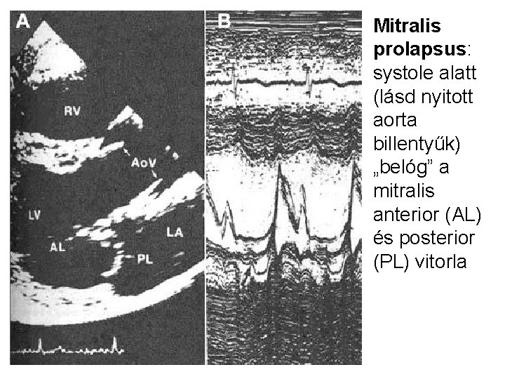 Mitralis prolapsus: systole alatt (lásd nyitott aorta billentyűk) „belóg” a mitralis anterior (AL) és