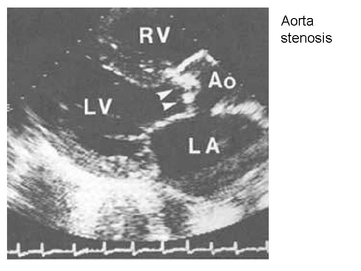 Aorta stenosis 