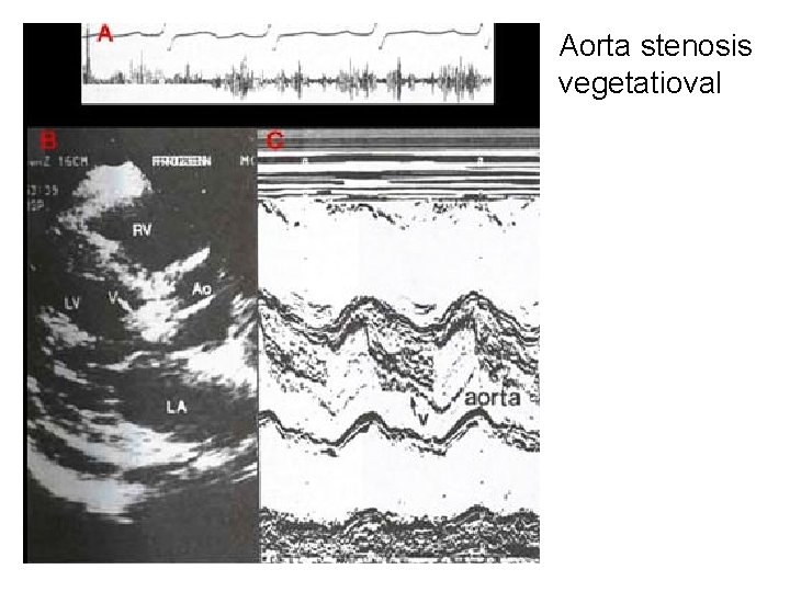 Aorta stenosis vegetatioval 