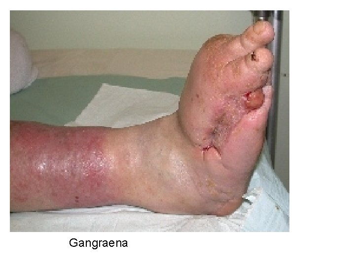 Gangraena 