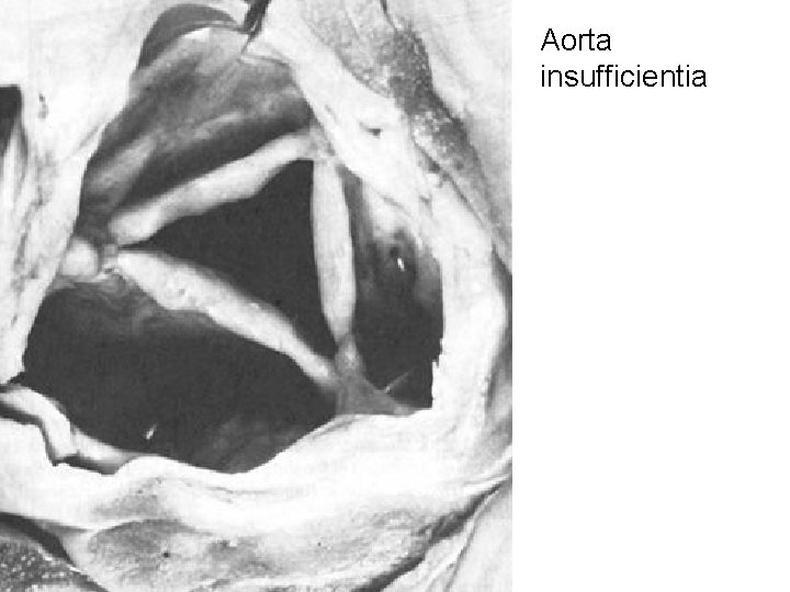Aorta insufficientia 
