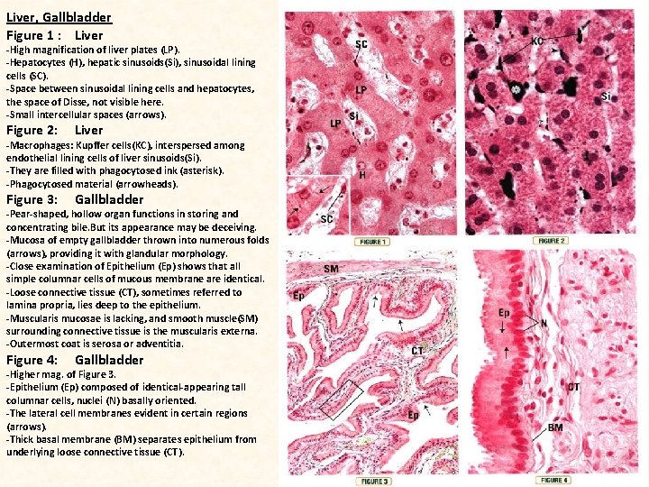 Liver, Gallbladder Figure 1 : Liver -High magnification of liver plates (LP). -Hepatocytes (H),