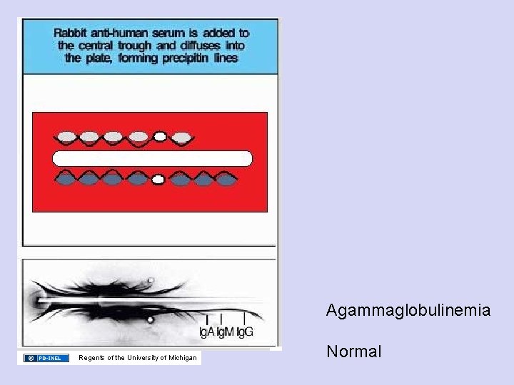 Agammaglobulinemia Regents of the University of Michigan Normal 