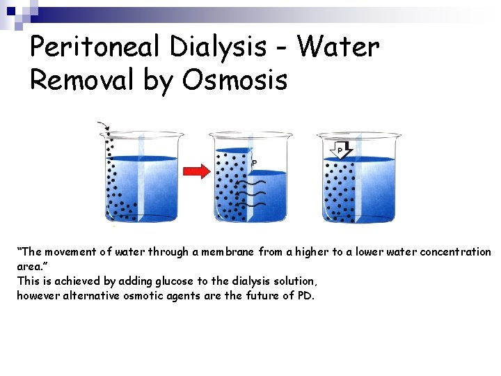 Peritoneal Dialysis - Water Removal by Osmosis “The movement of water through a membrane