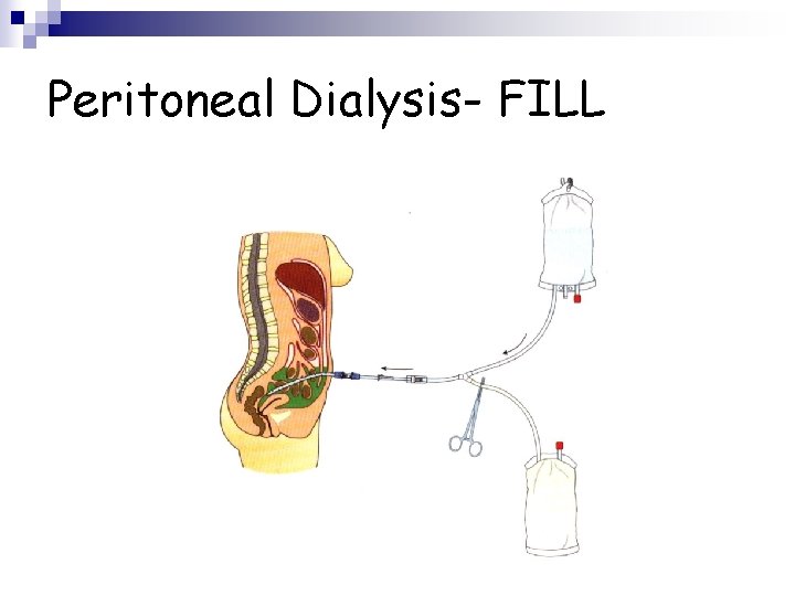 Peritoneal Dialysis- FILL 