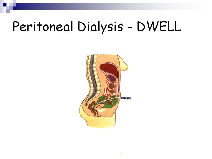 Peritoneal Dialysis - DWELL 