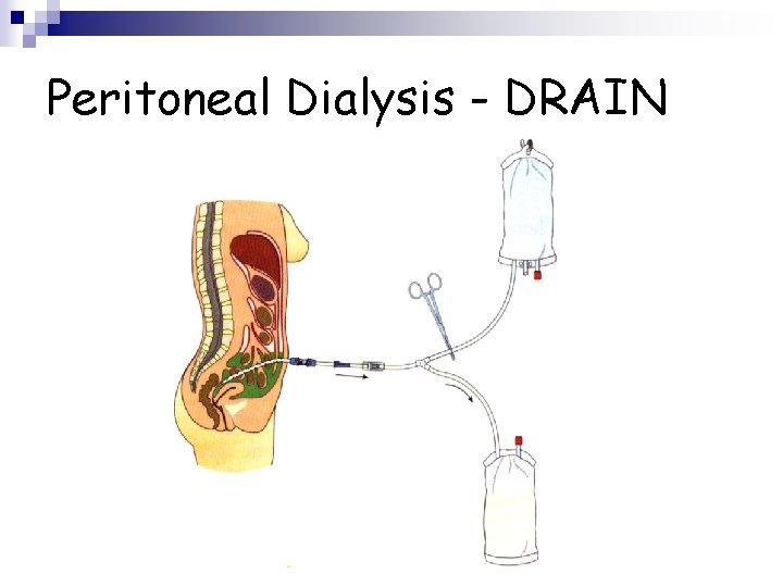 Peritoneal Dialysis - DRAIN 