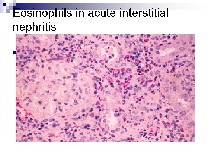 Eosinophils in acute interstitial nephritis n 