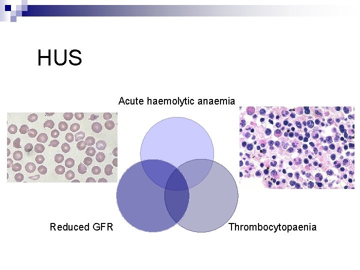 HUS Acute haemolytic anaemia Reduced GFR Thrombocytopaenia 