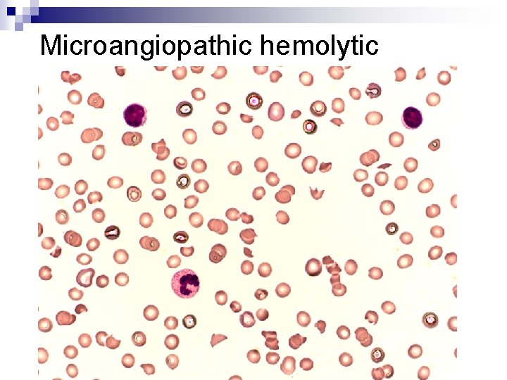 Microangiopathic hemolytic anemia 