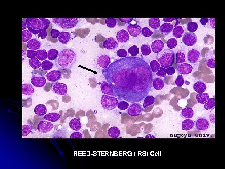 REED-STERNBERG ( RS) Cell 