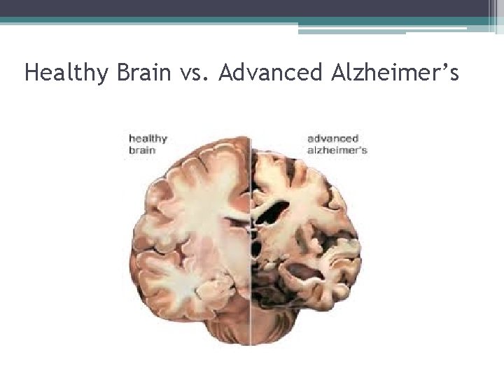 Healthy Brain vs. Advanced Alzheimer’s 