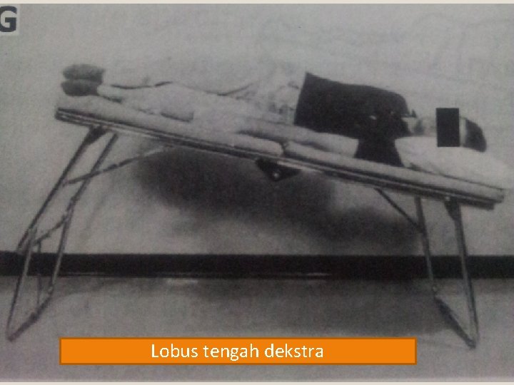 Lobus tengah dekstra 