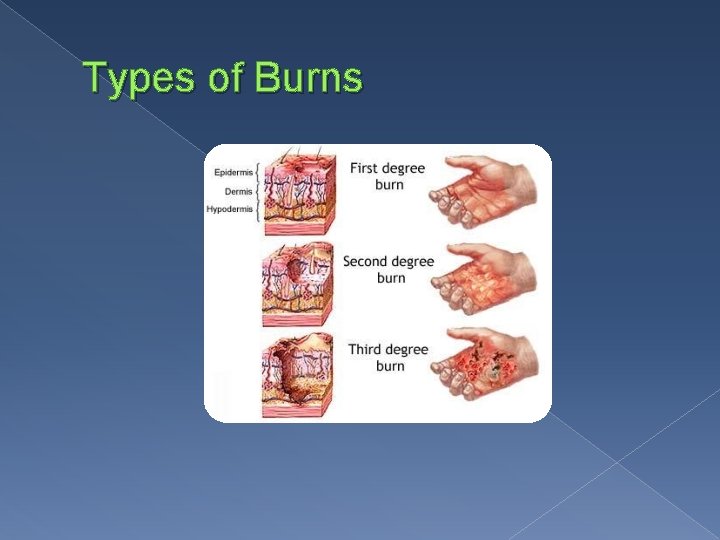 Types of Burns 