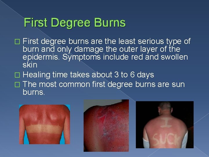 First Degree Burns First degree burns are the least serious type of burn and