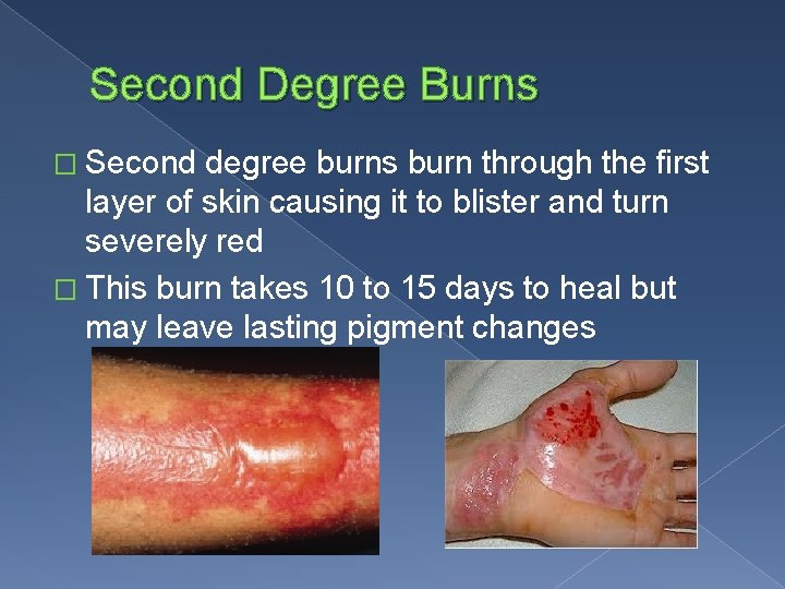 Second Degree Burns � Second degree burns burn through the first layer of skin