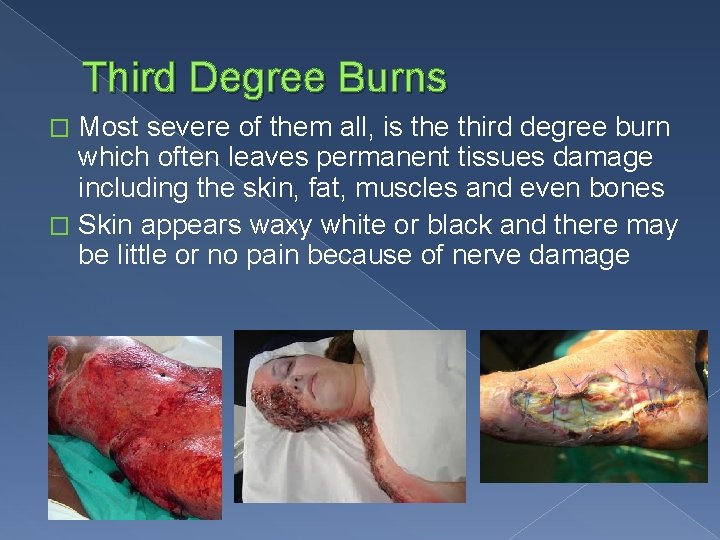 Third Degree Burns Most severe of them all, is the third degree burn which