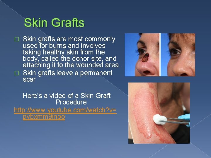 Skin Grafts Skin grafts are most commonly used for burns and involves taking healthy