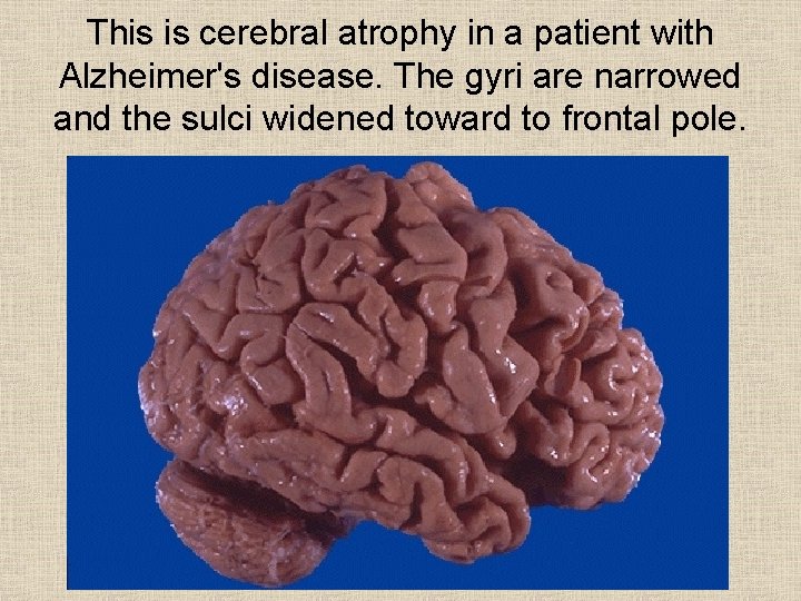 This is cerebral atrophy in a patient with Alzheimer's disease. The gyri are narrowed