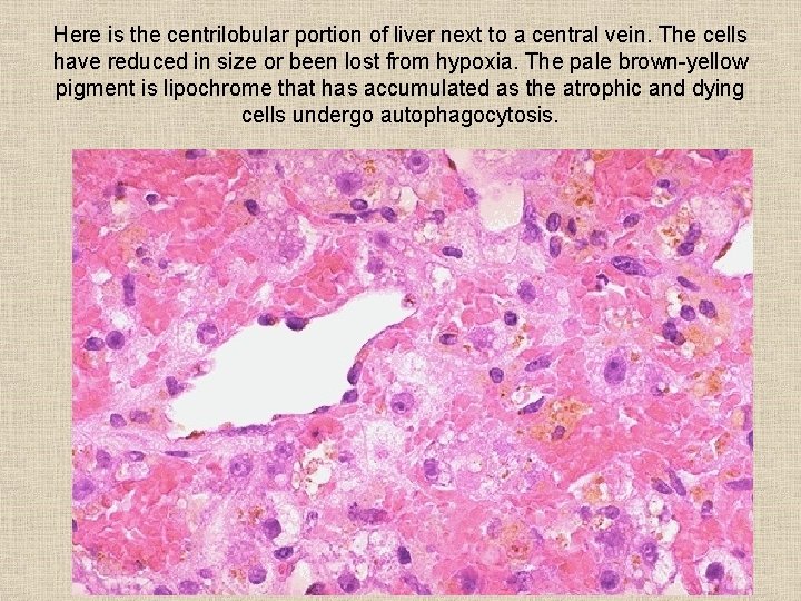 Here is the centrilobular portion of liver next to a central vein. The cells