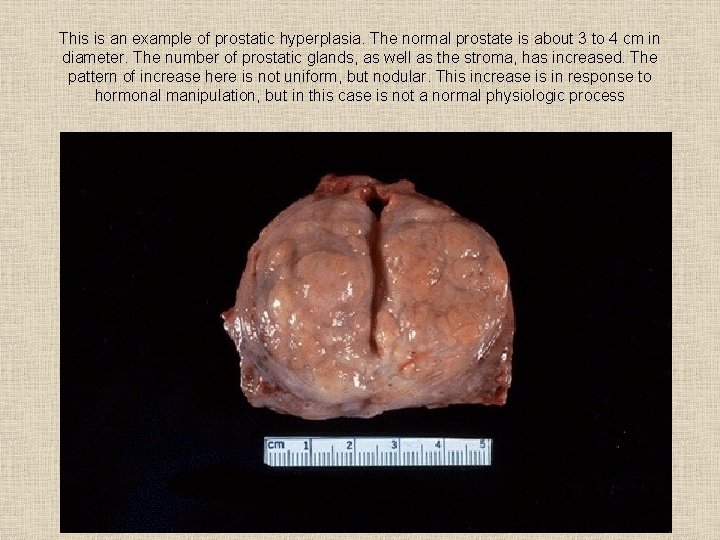 This is an example of prostatic hyperplasia. The normal prostate is about 3 to