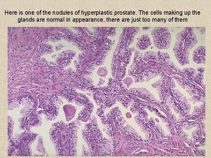 Here is one of the nodules of hyperplastic prostate. The cells making up the