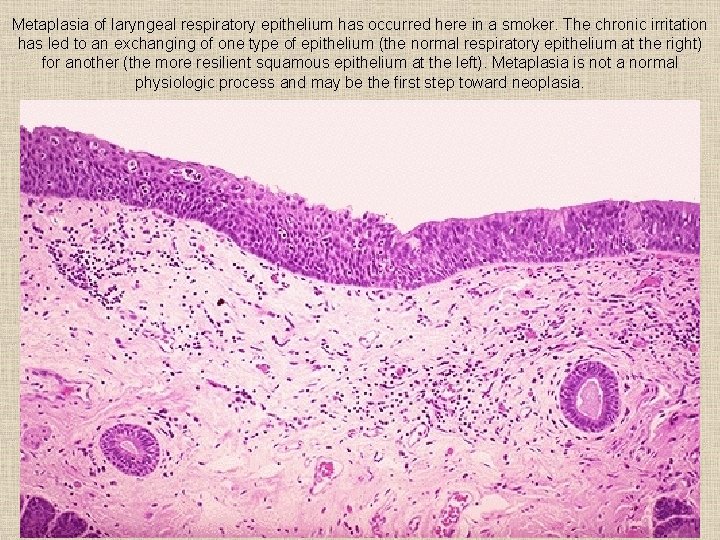 Metaplasia of laryngeal respiratory epithelium has occurred here in a smoker. The chronic irritation