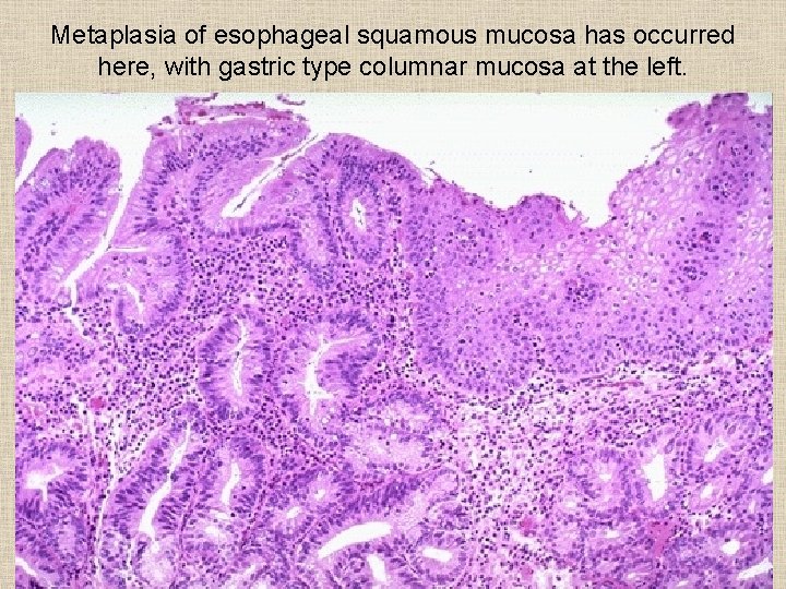 Metaplasia of esophageal squamous mucosa has occurred here, with gastric type columnar mucosa at