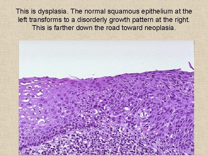 This is dysplasia. The normal squamous epithelium at the left transforms to a disorderly