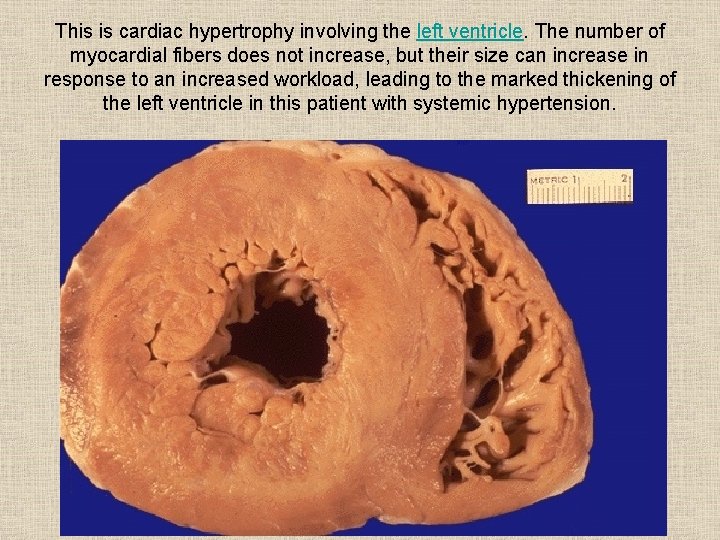 This is cardiac hypertrophy involving the left ventricle. The number of myocardial fibers does