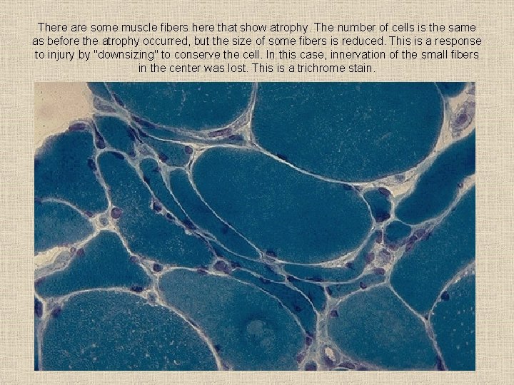 There are some muscle fibers here that show atrophy. The number of cells is