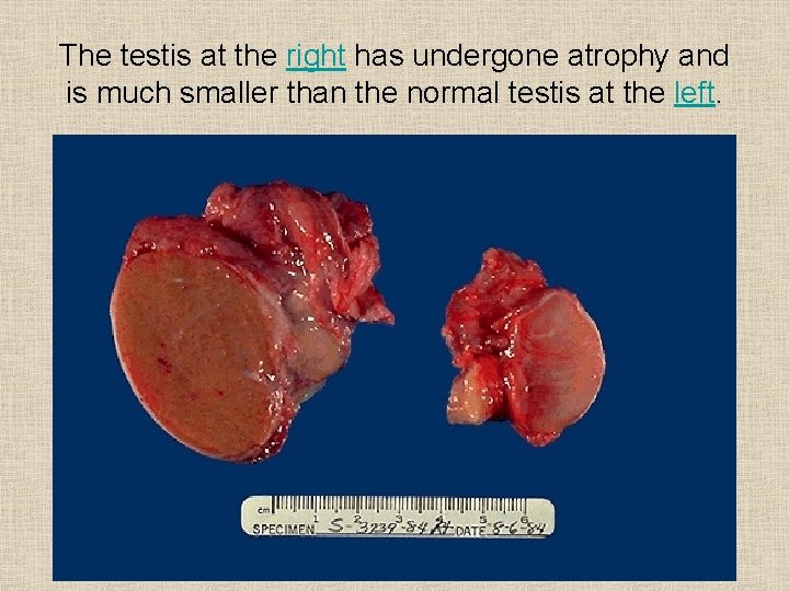 The testis at the right has undergone atrophy and is much smaller than the