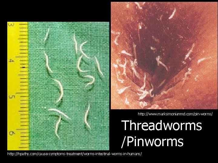 http: //www. marksimonianmd. com/pin-worms/ Threadworms /Pinworms http: //hpathy. com/cause-symptoms-treatment/worms-intestinal-worms-in-humans/ 