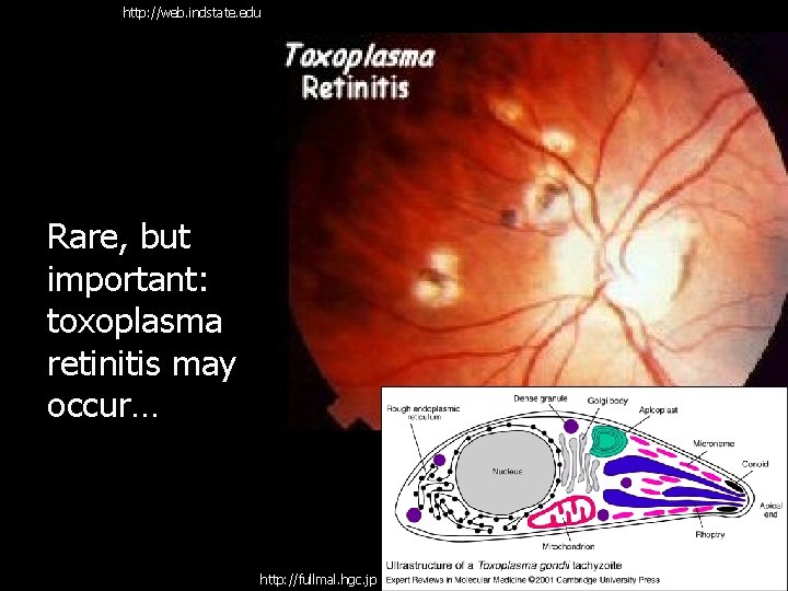 http: //web. indstate. edu Rare, but important: toxoplasma retinitis may occur… http: //fullmal. hgc.