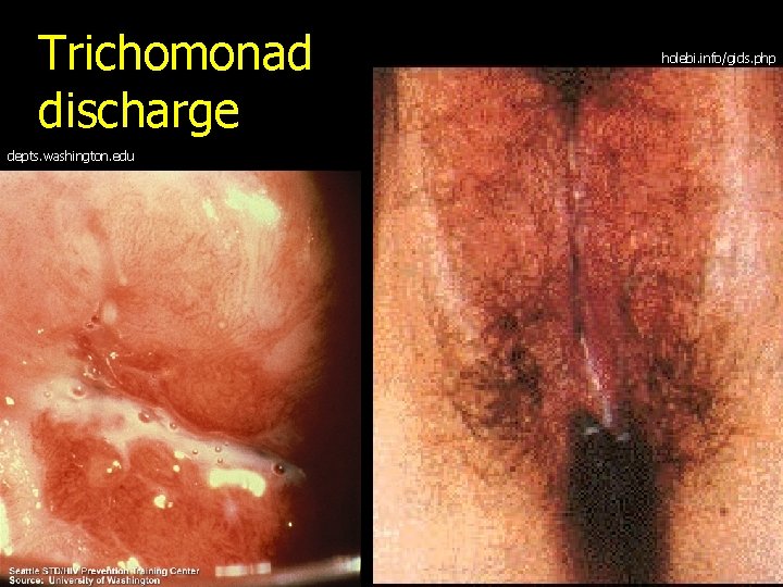 Trichomonad discharge depts. washington. edu holebi. info/gids. php 