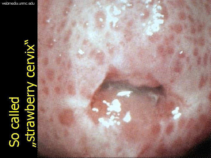 So called „strawberry cervix“ webmedia. unmc. edu 