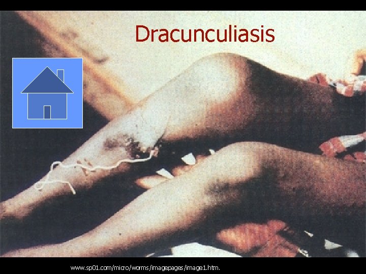 Dracunculiasis www. sp 01. com/micro/worms/imagepages/image 1. htm. 