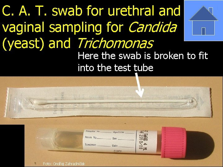 C. A. T. swab for urethral and vaginal sampling for Candida (yeast) and Trichomonas